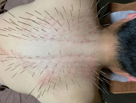 鍼処shirakawa 栃木院 小山 佐野 栃木の鍼灸院