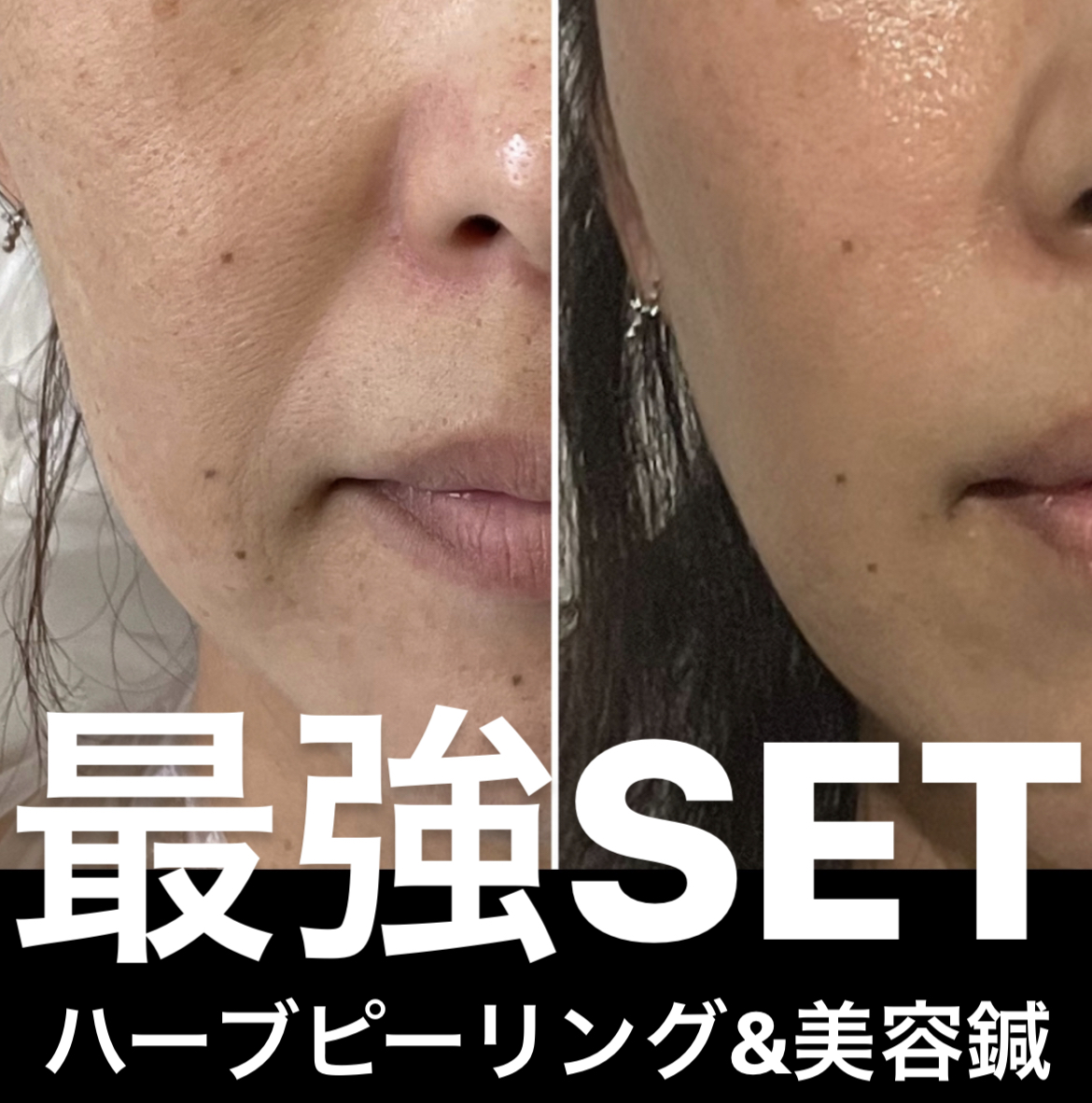 美容外科医複数人監修美容鍼 MAOの美容鍼2023 書籍】MAOの美容