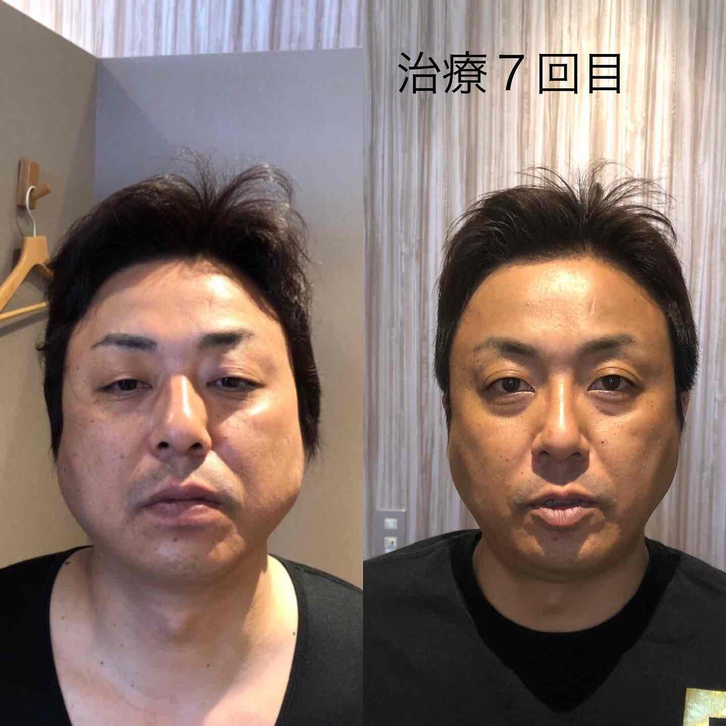 鍼灸大成 上下巻 健康・医学