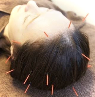 宇多津【頭痛・腰痛専門】鍼灸院 SHIMADA 「痛みと不調に特化