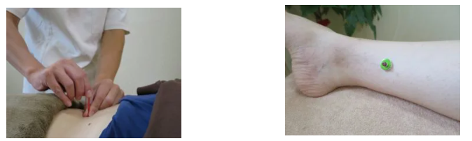 腰に鍼をする画像、及び足にお灸をする画像