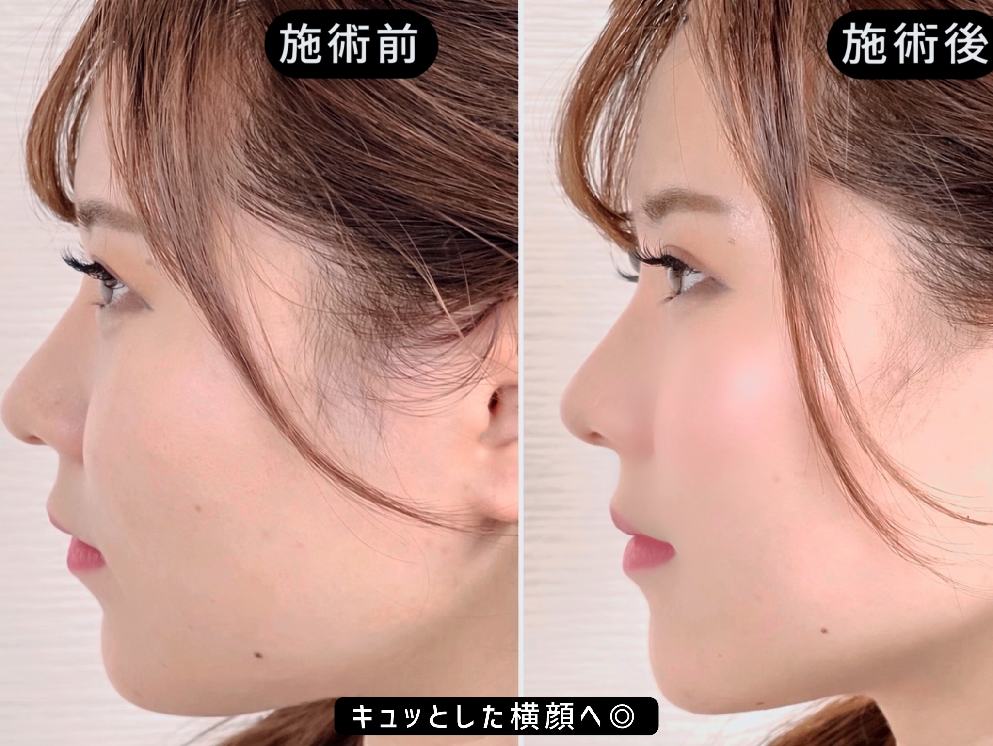 美容外科医複数人監修美容鍼 MAOの美容鍼2023 書籍】MAOの美容鍼2023 | 幸田マオ オフィシャル販売サイト